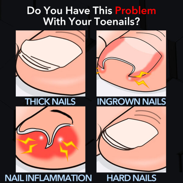 Professional Toenail Clippers for Thick and Ingrown Nails - Image 4